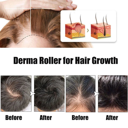 Derma Roller for Hair Growth (0.5mm)