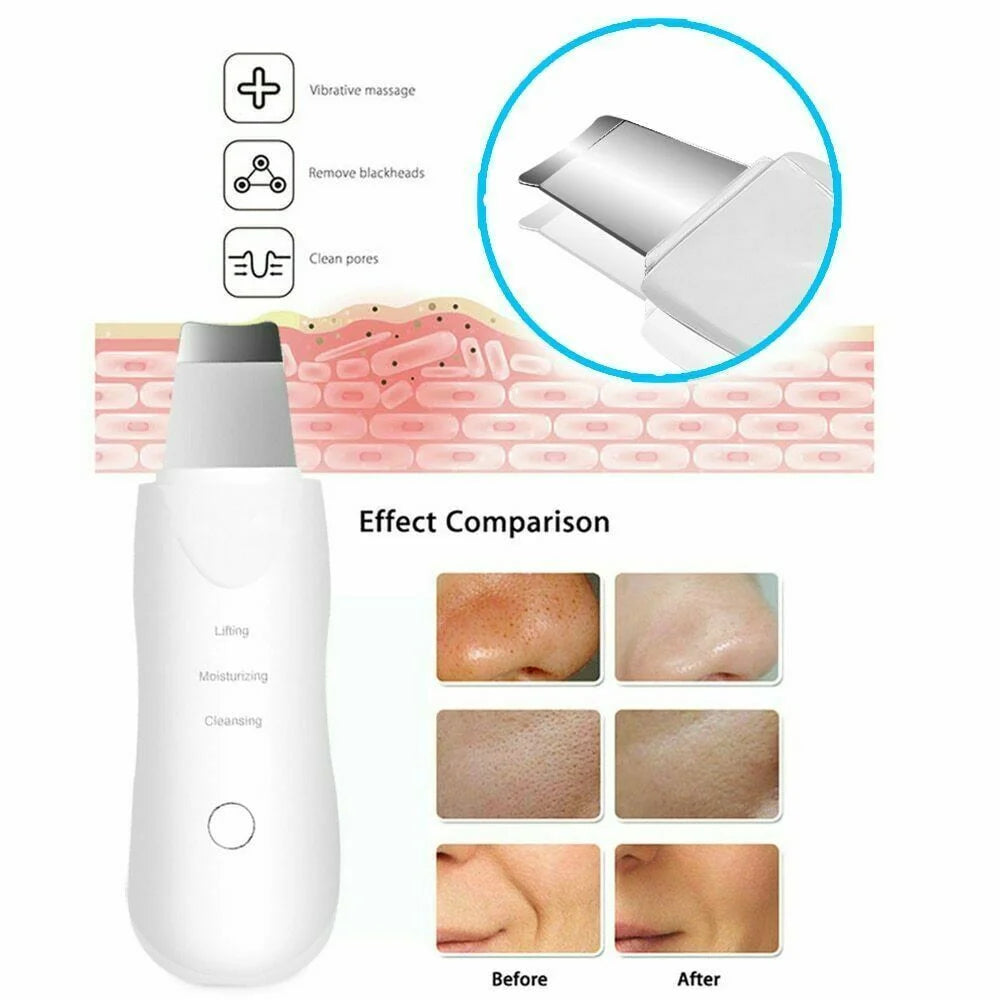 Ultrasonic Skin Scrubber & Face Spatula – Blackhead Remover & Pore Cleanser