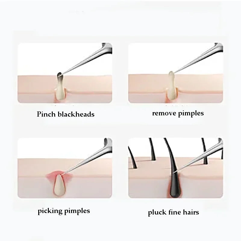 Blackhead Removal Tool Kit – Acne & Pore Cleansing Set (4–11 Pcs)