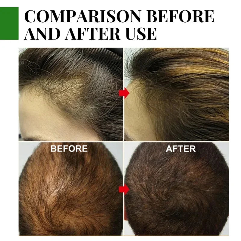 Rosemary Essential Oil Hair Growth Oil – Pure Natural 30ml